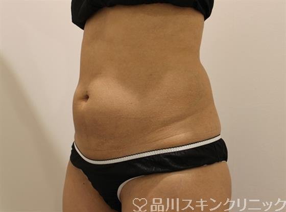 症例NO.46651のAFTER写真