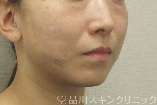 症例NO.73965のAFTER写真