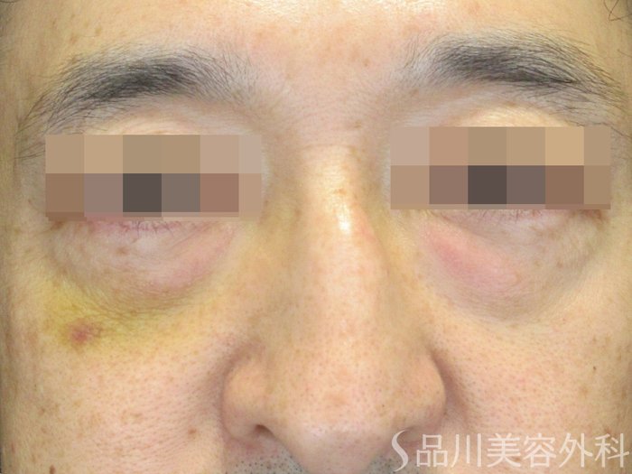 症例NO.71314のBEFORE写真