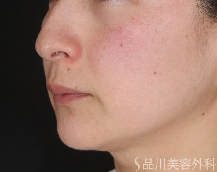 症例NO.72614のBEFORE写真