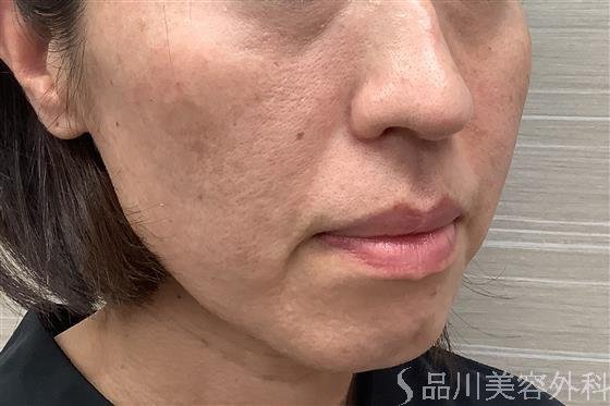 症例NO.55256のBEFORE写真