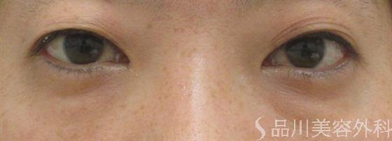 症例NO.16236のBEFORE写真