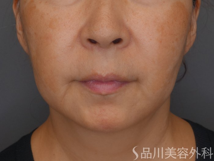 症例NO.65694のBEFORE写真