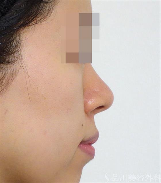 症例NO.47081のBEFORE写真
