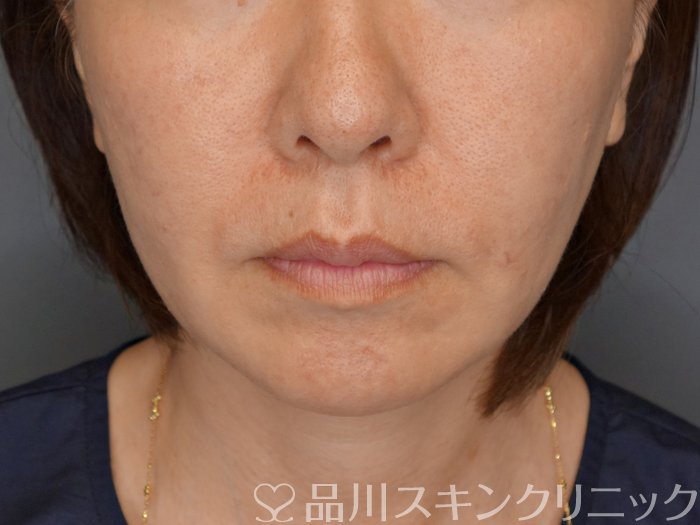 症例NO.71298のBEFORE写真