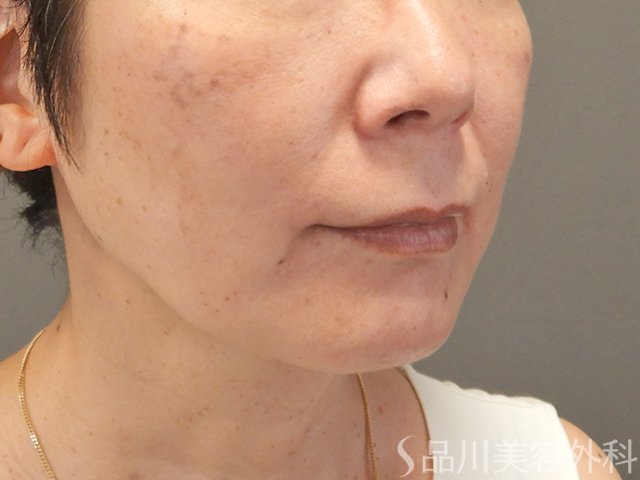 症例NO.74575のBEFORE写真