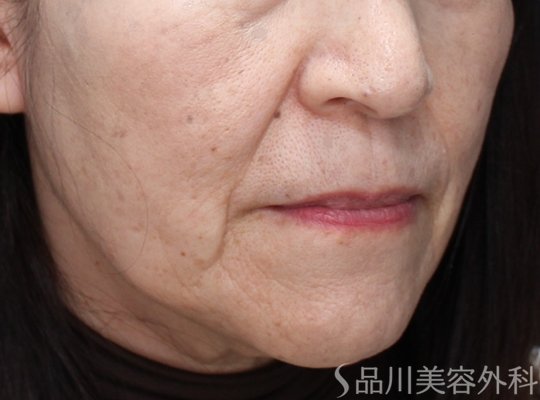 症例NO.73504のBEFORE写真