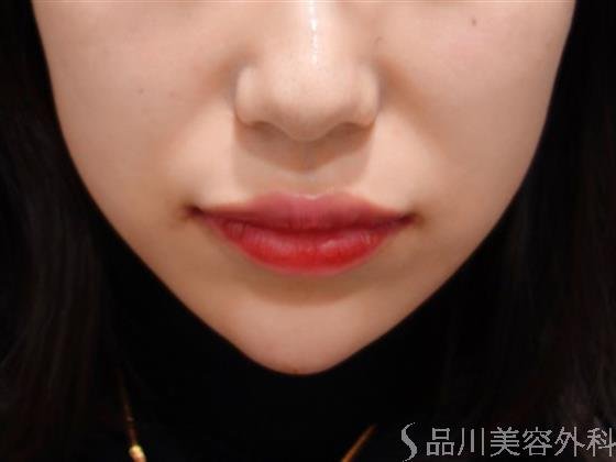 症例NO.50227のAFTER写真