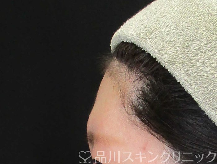 症例NO.67808のBEFORE写真