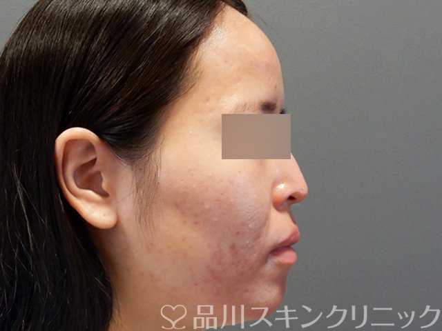 症例NO.71632のAFTER写真