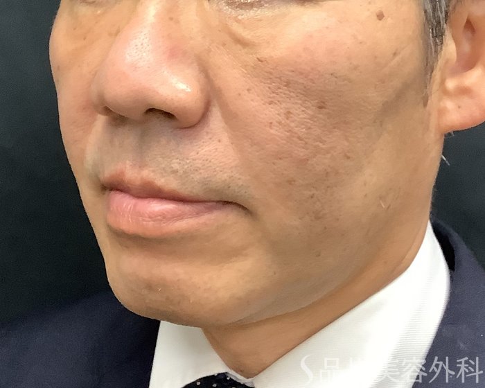 症例NO.69643のAFTER写真