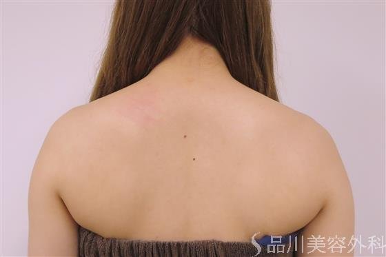 症例NO.48453のBEFORE写真