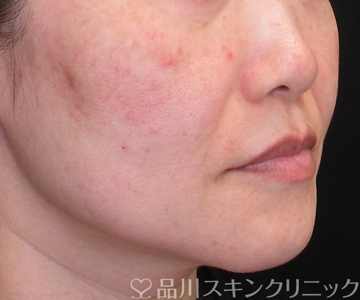 症例NO.75071のAFTER写真