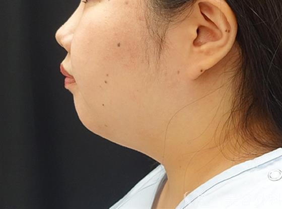 症例NO.40591のBEFORE写真