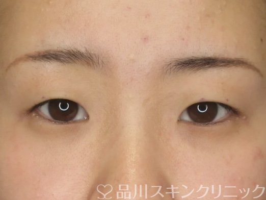 症例NO.69332のBEFORE写真