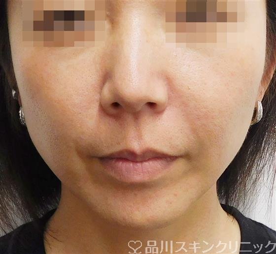 症例NO.56091のAFTER写真