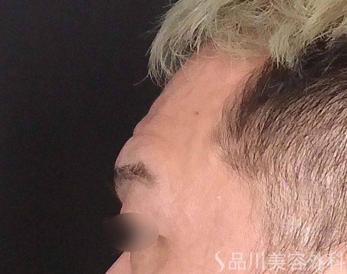 症例NO.70152のAFTER写真