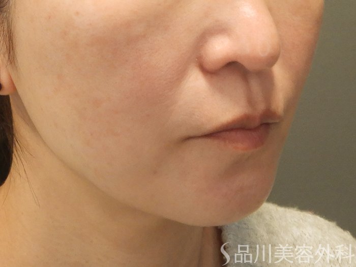 症例NO.70357のAFTER写真