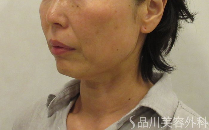 症例NO.72024のBEFORE写真