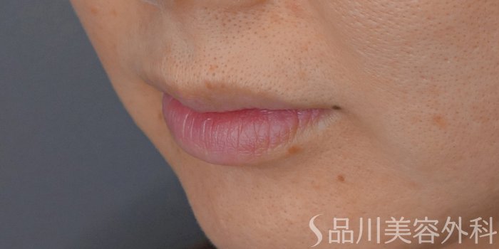 症例NO.72337のBEFORE写真