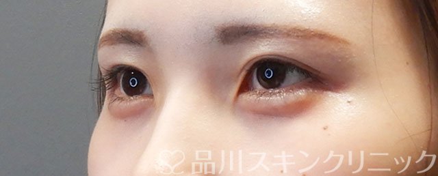 症例NO.73072のBEFORE写真