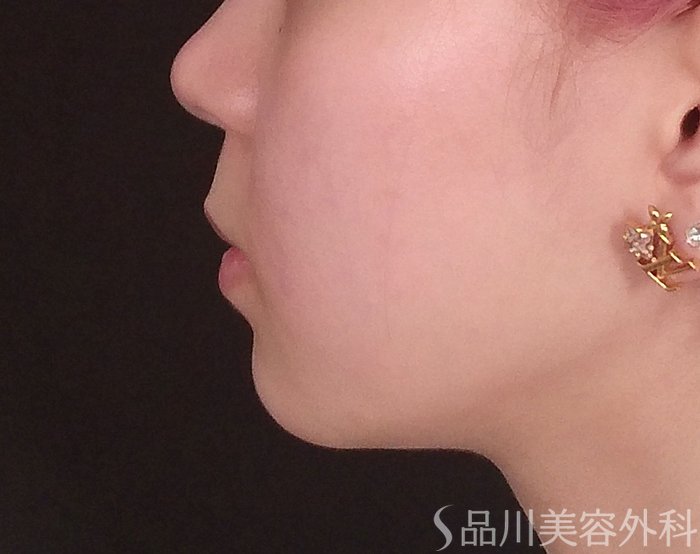 症例NO.69820のBEFORE写真