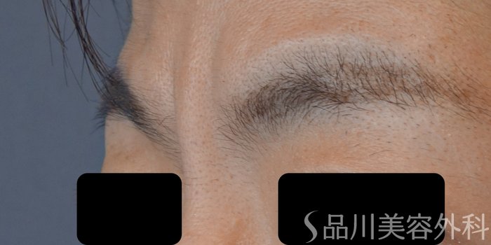 症例NO.72169のBEFORE写真