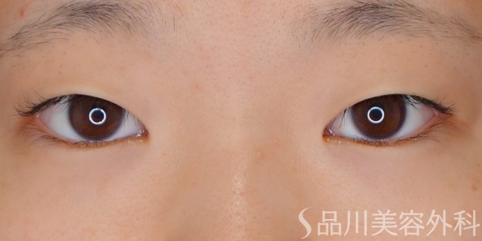 症例NO.70131のBEFORE写真