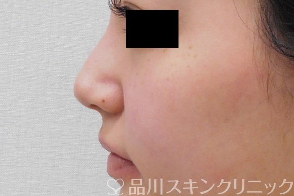 症例NO.69564のBEFORE写真