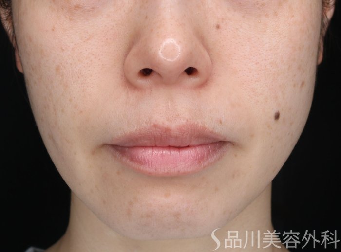 症例NO.73047のAFTER写真