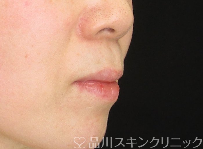 症例NO.62751のBEFORE写真