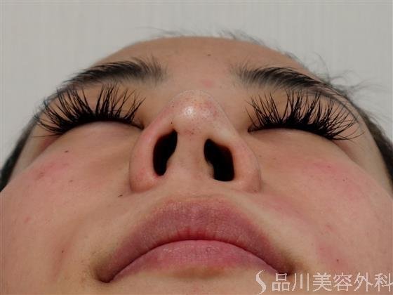 症例NO.32283のAFTER写真