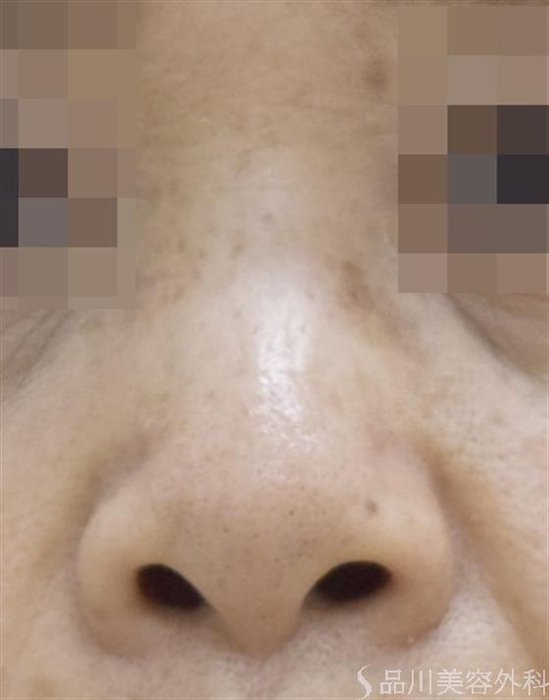 症例NO.48901のBEFORE写真