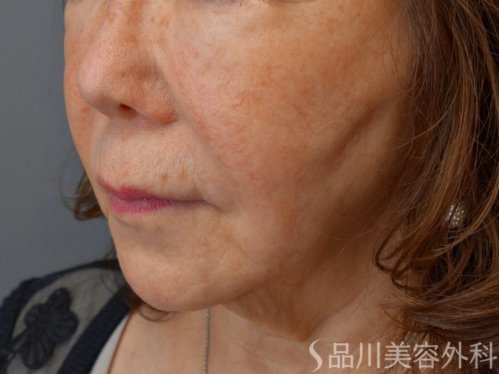 症例NO.73019のBEFORE写真