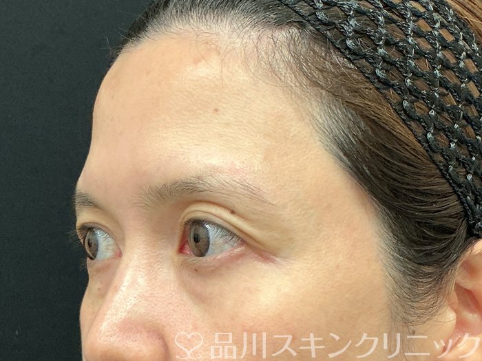 症例NO.75221のBEFORE写真
