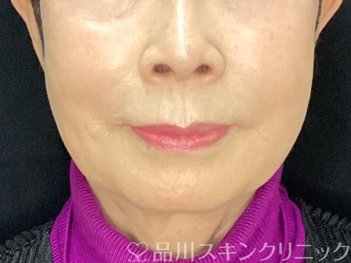 症例NO.73212のAFTER写真