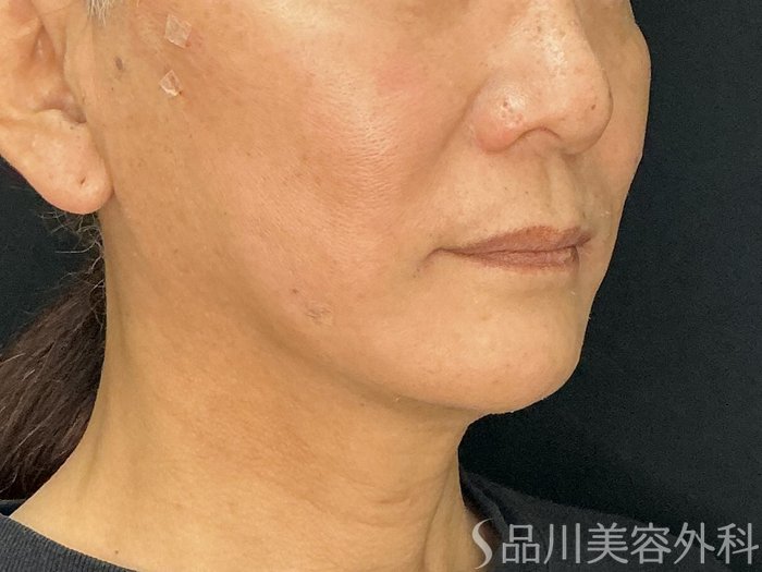 症例NO.71749のAFTER写真