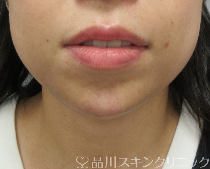 症例NO.74761のAFTER写真