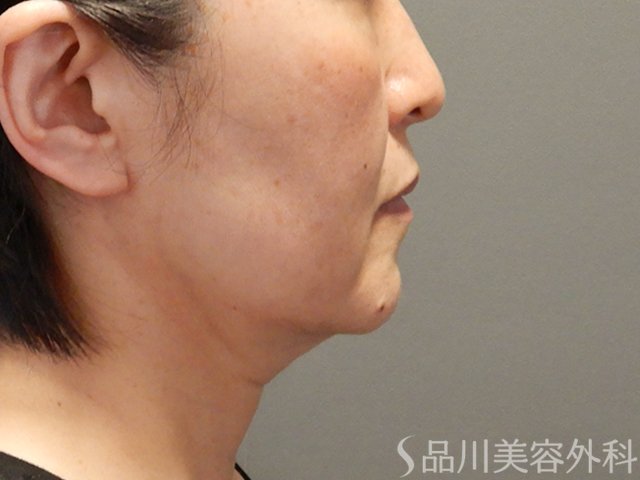 症例NO.75060のBEFORE写真