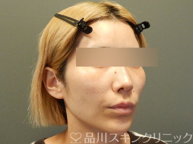 症例NO.65754のBEFORE写真