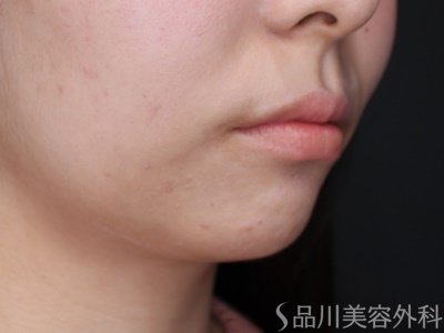 症例NO.65118のBEFORE写真