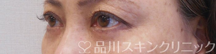 症例NO.70129のAFTER写真