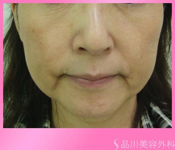 症例NO.3270のBEFORE写真