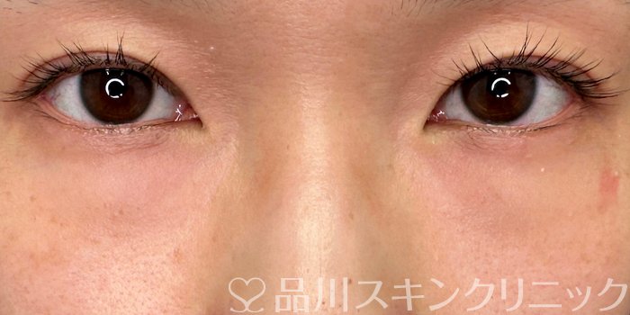 症例NO.65483のBEFORE写真