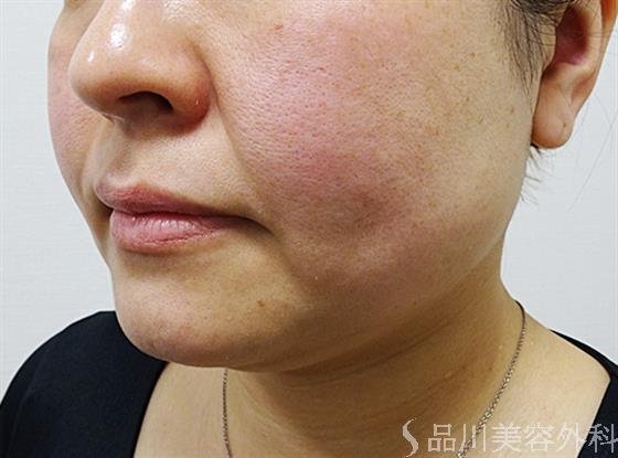 症例NO.55619のBEFORE写真