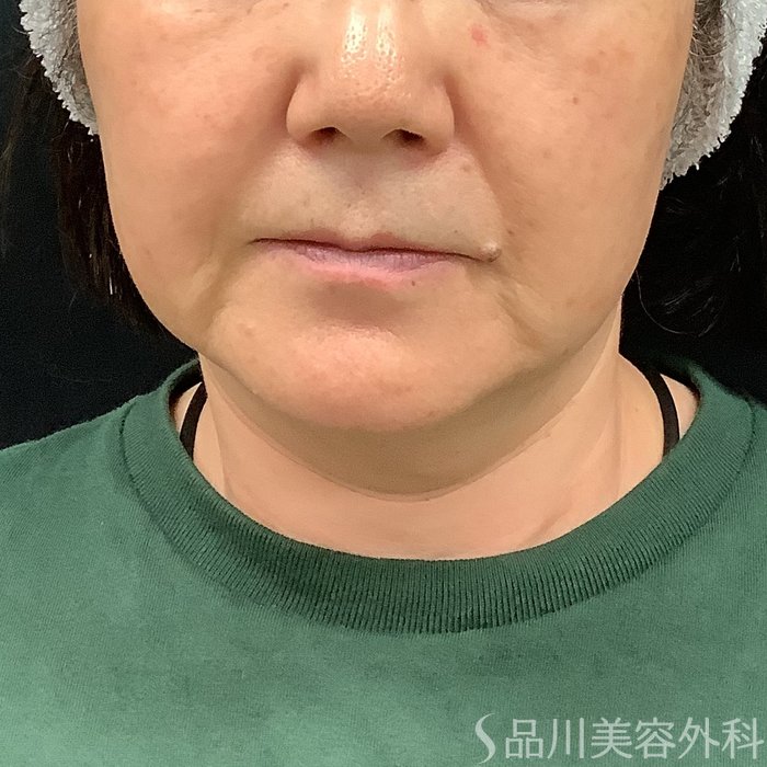 症例NO.75332のBEFORE写真