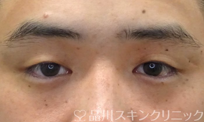 症例NO.69397のBEFORE写真