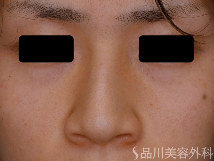 症例NO.74697のBEFORE写真