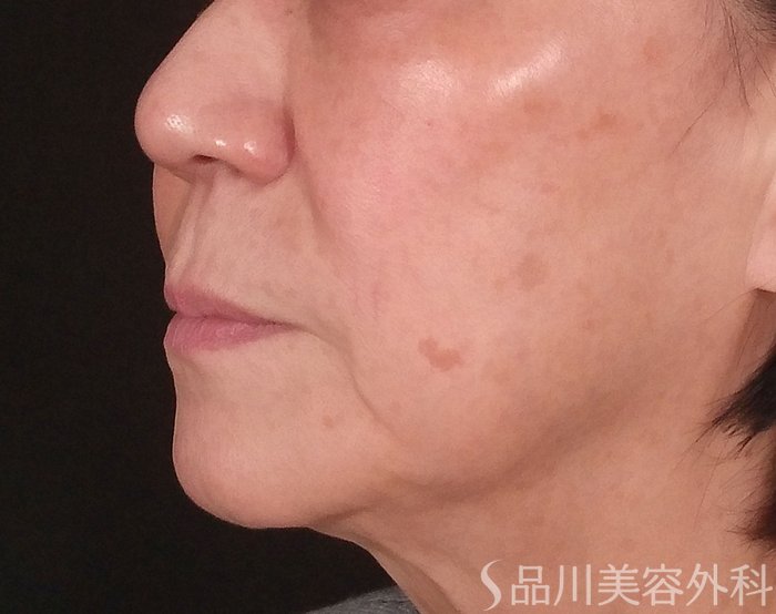 症例NO.69847のBEFORE写真