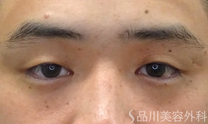 症例NO.69397のBEFORE写真